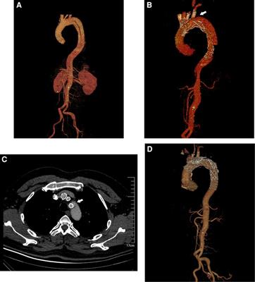 Risk factors for target vessel endoleaks after physician-modified fenestrated or branched endovascular aortic arch repair: A retrospective study